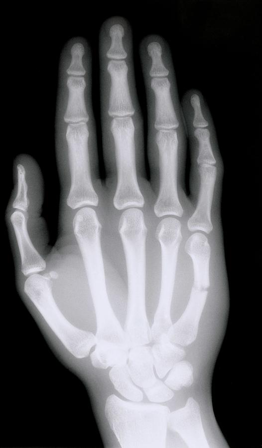 X-ray Of Broken Bone In Right Hand Photograph by Science Photo Library