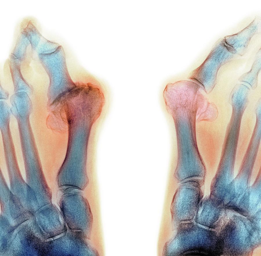 X-ray Of Bunions On The Toes Photograph by Mike Devlin/science Photo Library