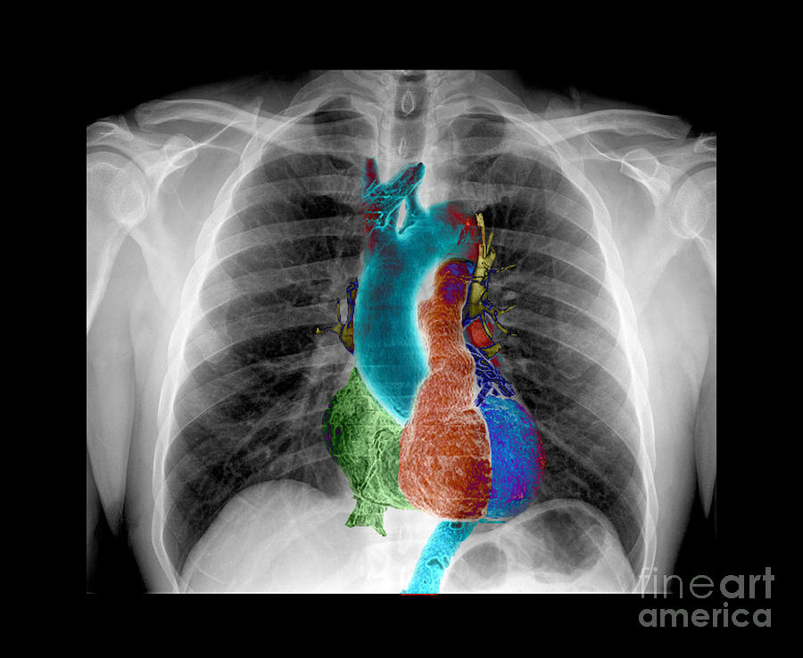 X-ray Of Chest And Heart Photograph by Living Art Enterprises