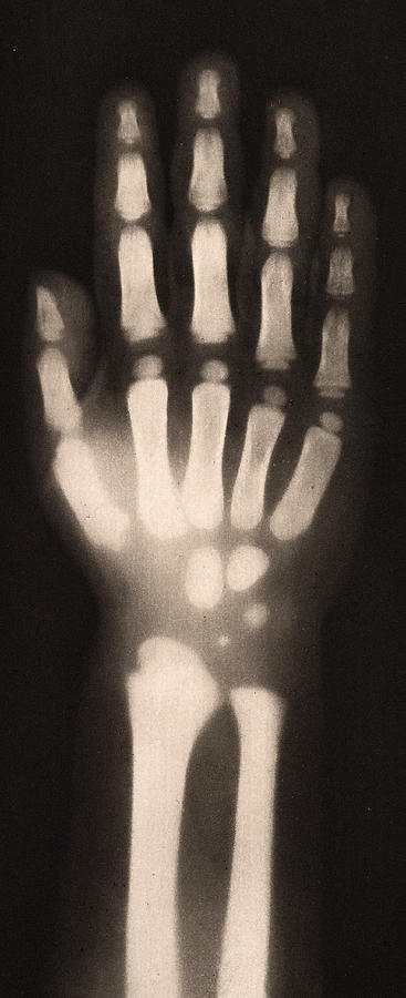X-ray Of Childs Hand, 1896 Photograph by Metropolitan Museum of Art