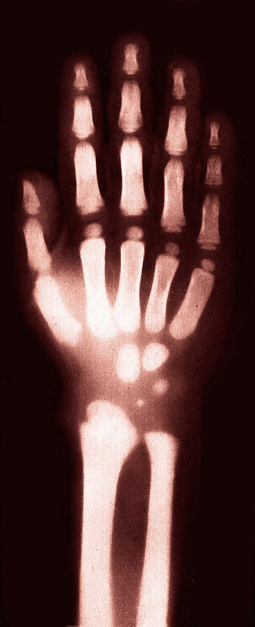 X-ray Of Childs Hand, 1896 Photograph by Science Source