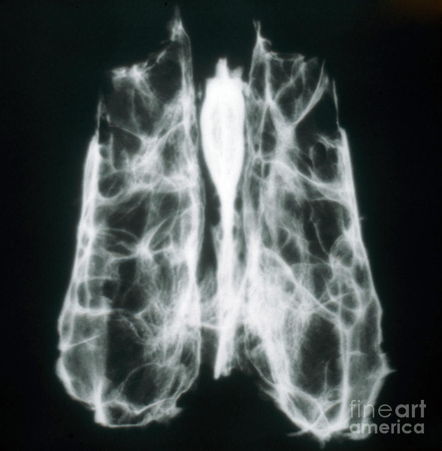 Anatomy Photograph - X-ray Of Ethmoid Bone by VideoSurgery