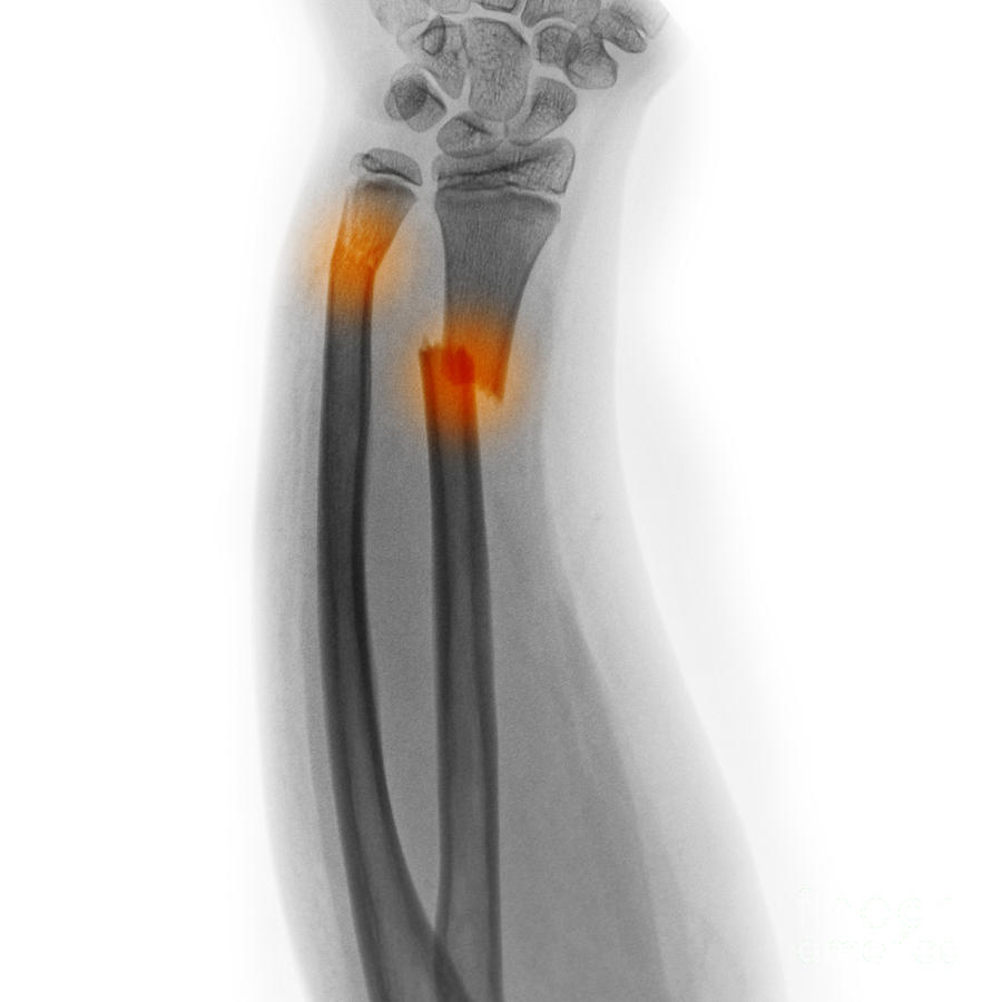X-ray Of Fractured Forearm Photograph by Scott Camazine