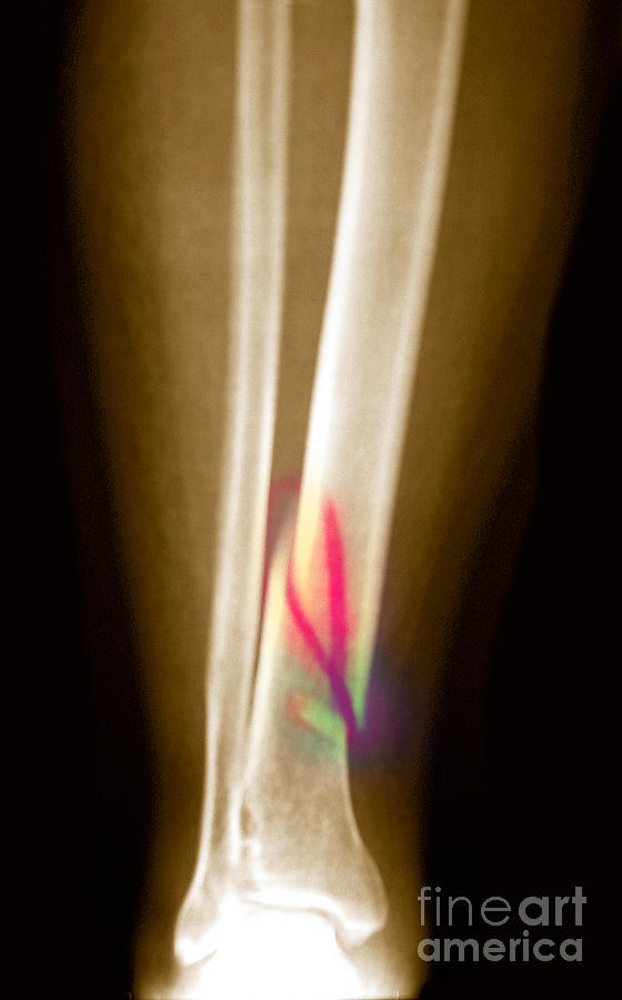 X-ray Of Fractured Tibia Photograph by Scott Camazine