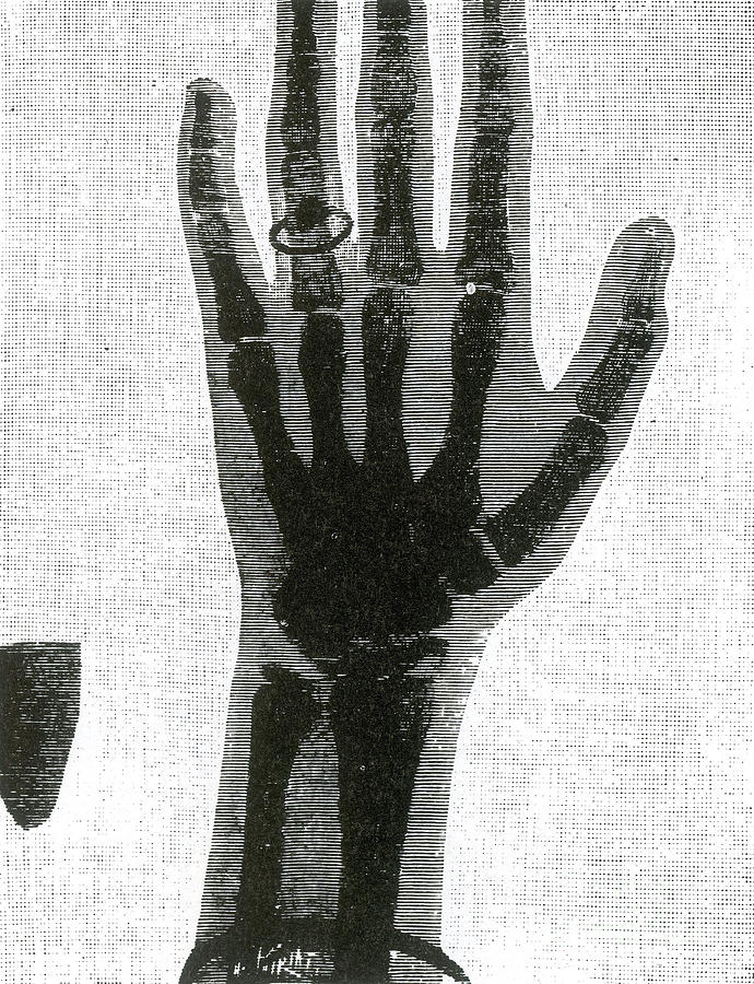 X-ray Of Girls Hand, 1896 Photograph by Science Source