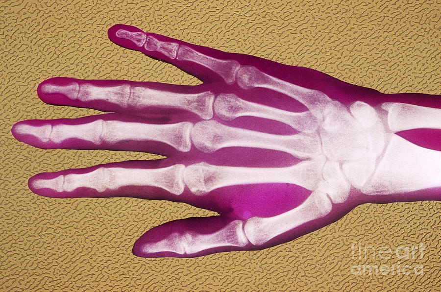 X-ray Photograph - X-ray Of Hand by Chris Bjornberg