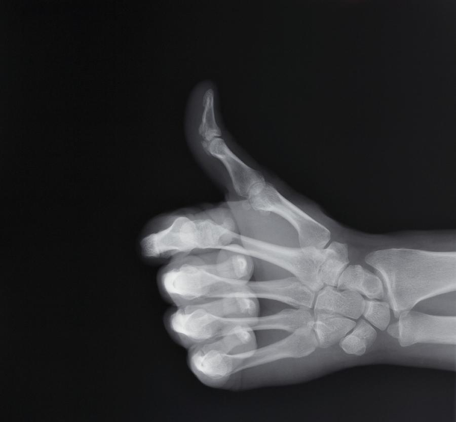 X-ray of hand making thumbs up gesture Photograph by ER Productions Limited