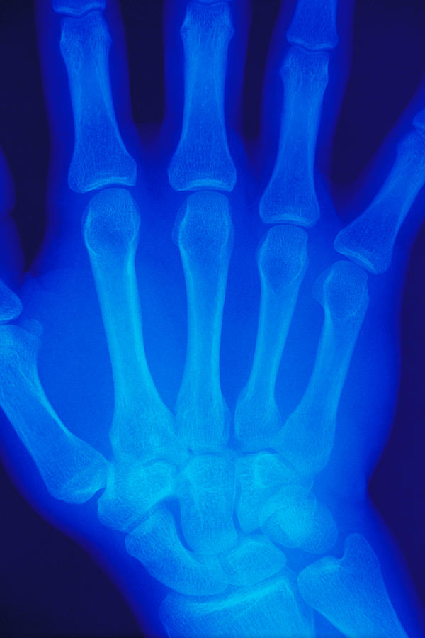 X-ray Of Hand Photograph by Phillip Hayson
