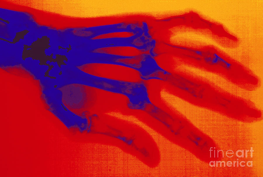 X-ray Of Hand With Rheumatoid Arthritis Photograph by Scott Camazine