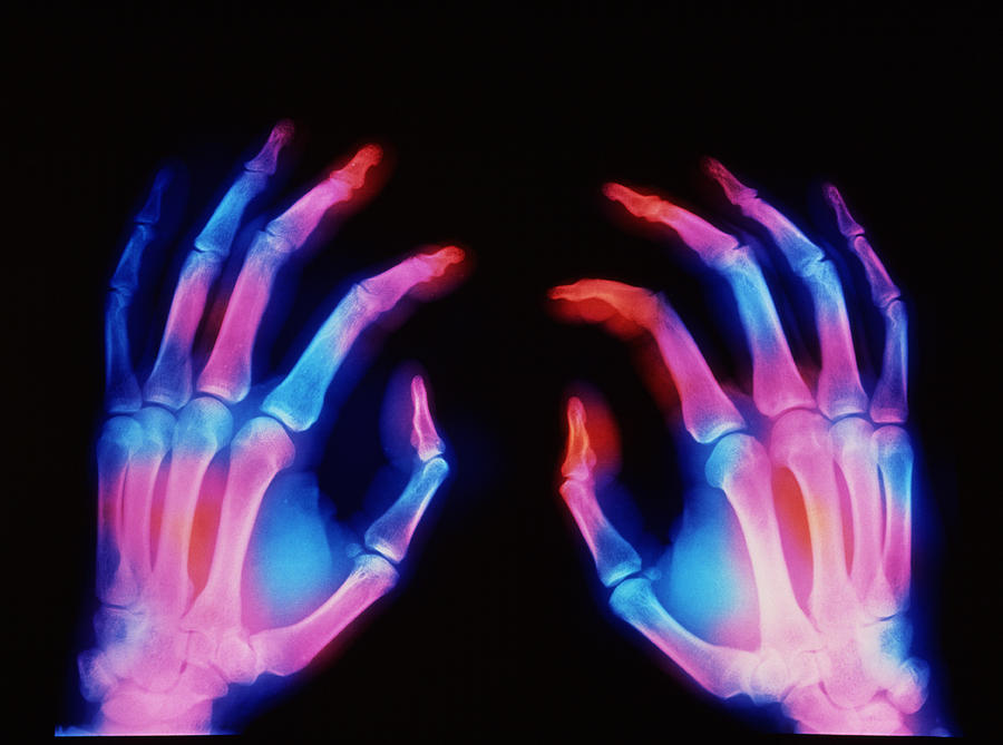 X-ray Of Hands Photograph by Science Photo Library - Fine Art America