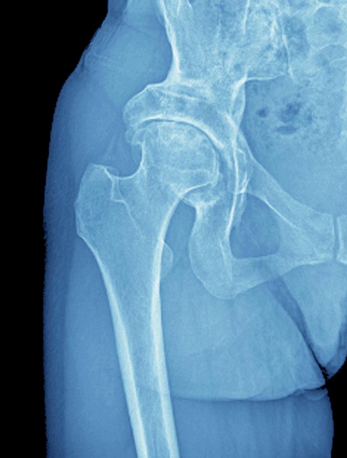 xray of normal hip