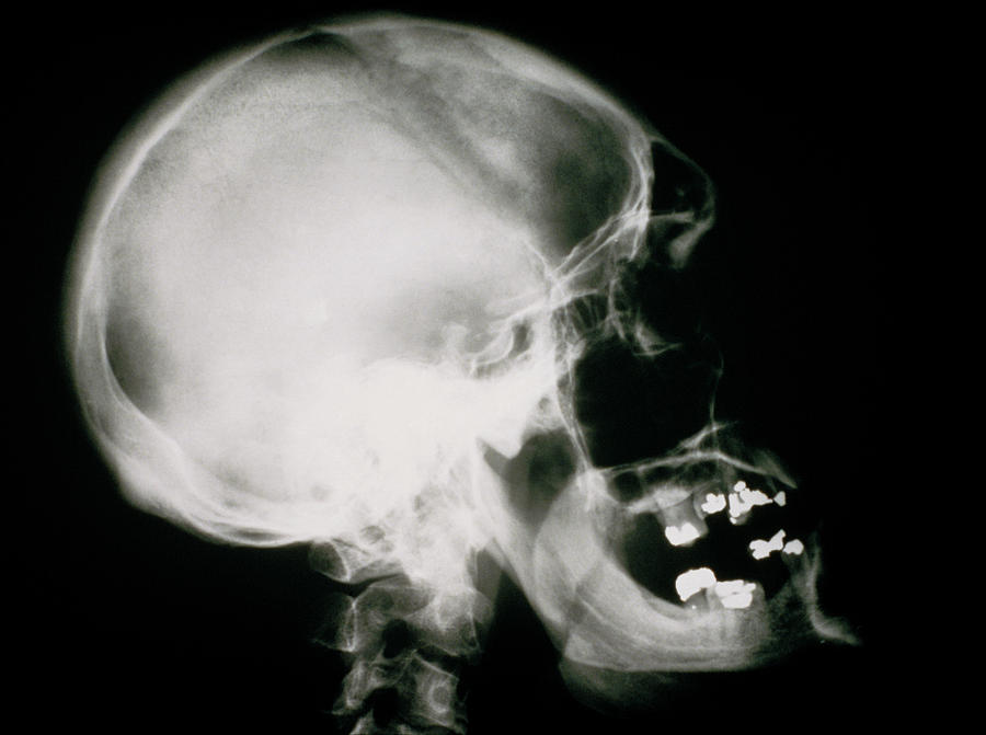X Ray Of Human Skull Showing Acromegaly Photograph By Science Photo ...