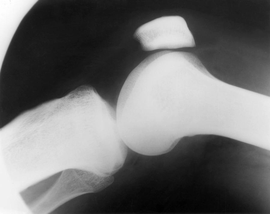 X-ray Of Knee Arthritis Photograph by AFIP/Science Source