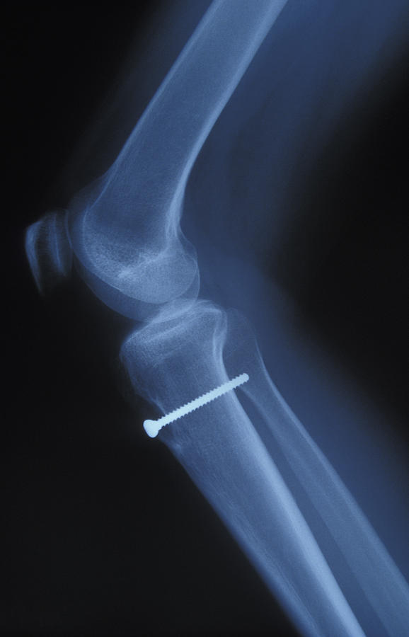 X-ray Of Knee With Screw Photograph by Mark Harmel