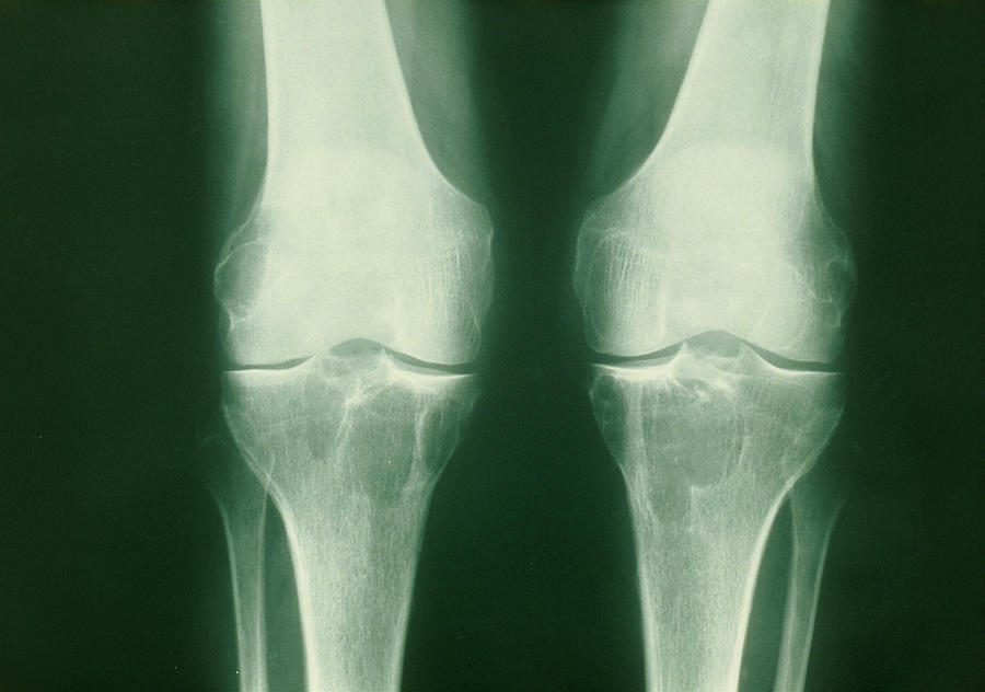 X Ray Of Knees With Bakers Cysts Photograph By Medical Photo Nhs