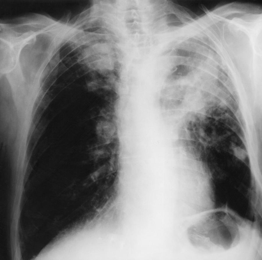 Xray Of Lung Cancer Photograph by AFIP/Science Source