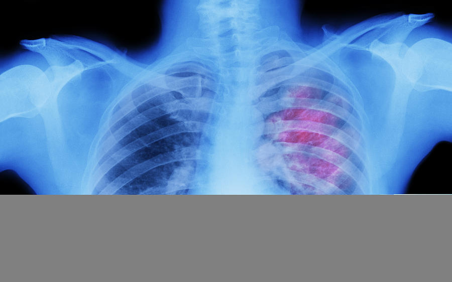 X-ray of lung showing chest cancer Photograph by Peter Dazeley