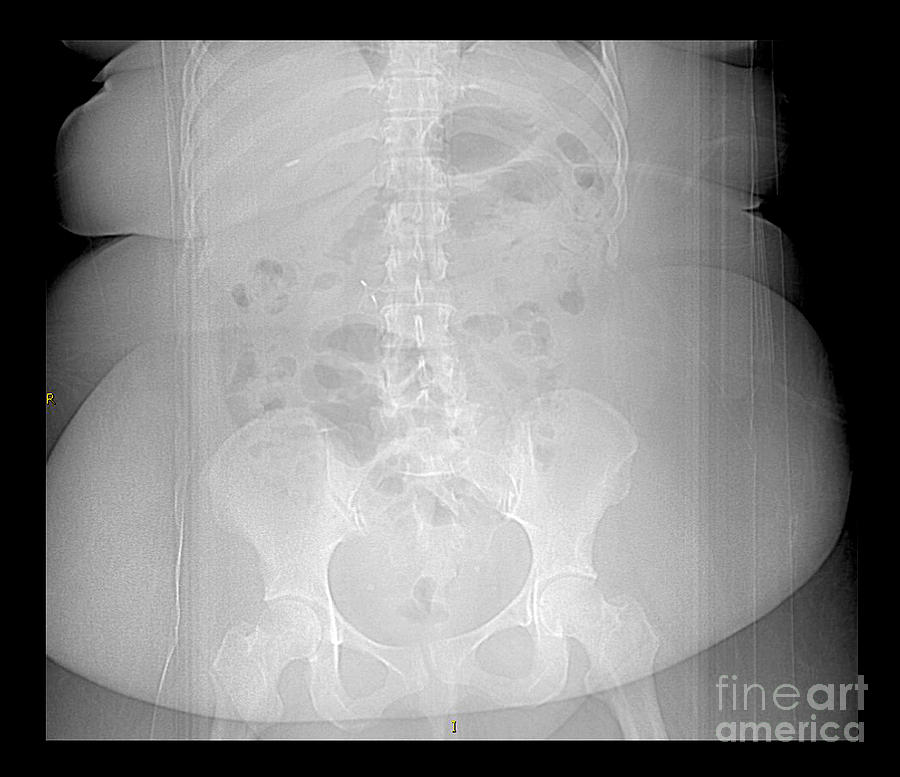 Science Photograph - X-ray Of Morbidly Obese Patient by Living Art Enterprises