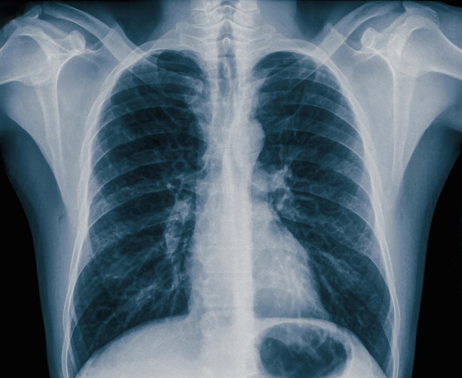 X-ray of normal healthy chest front view, 36 year old male Photograph by Cultura RM Exclusive/PhotoStock-Israel