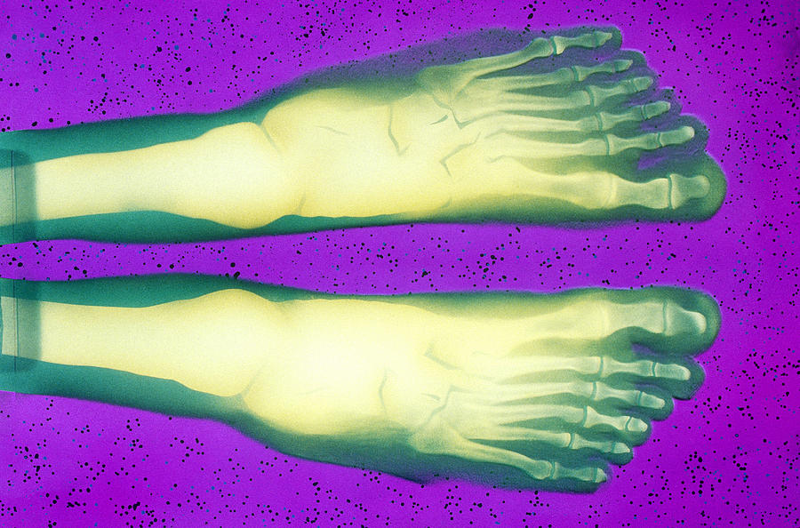 X-ray Of Polydactyl Feet Photograph by Chris Bjornberg
