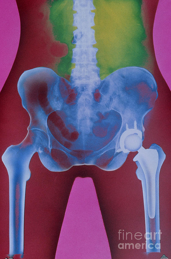 X-ray Of Prosthetic Hip Photograph by Chris Bjornberg