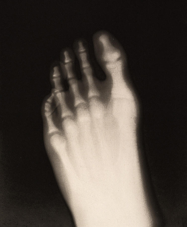 X-ray Of Teenage Boys Foot, 1896 Photograph by Metropolitan Museum of Art
