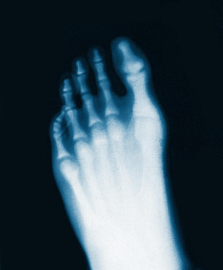 X-ray Of Teenage Boys Foot, 1896 Photograph by Science Source