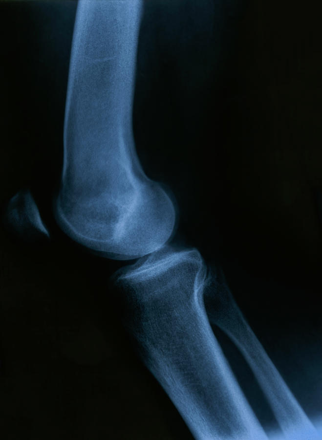 Human Knee Photograph - X Ray of the Knee  by Marek Poplawski