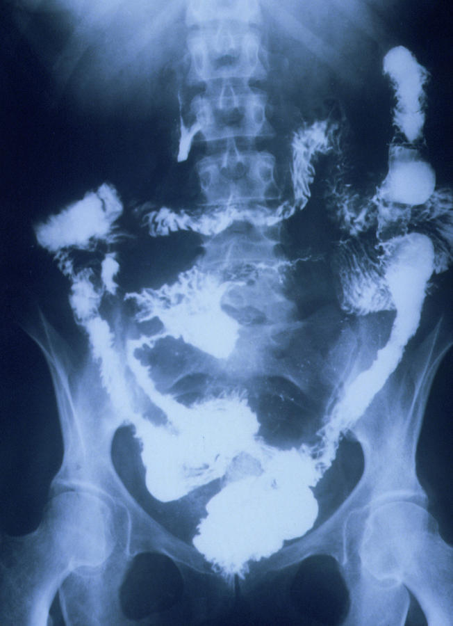 X-ray Of The Lower Gut In Crohn's Disease Photograph by St Bartholomew ...