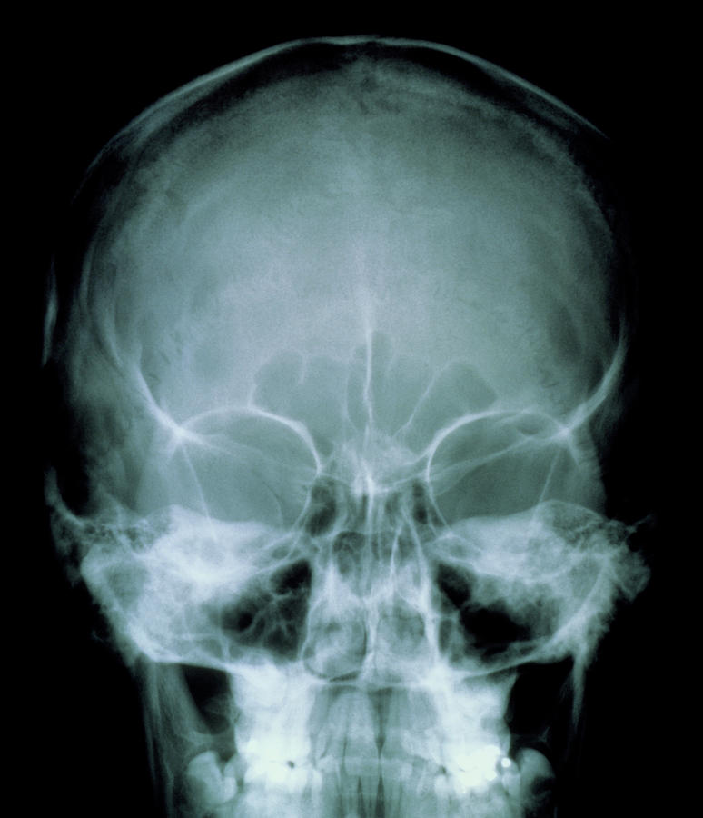 X-ray Of The Skull Front View Photograph by Science Photo Library ...