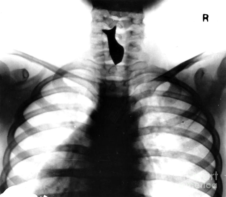 X-ray Of Trinket Swallowed By Child Photograph by Science Source