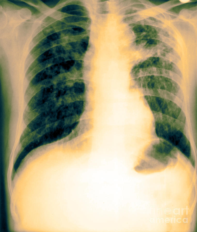 Xray Of Tuberculosis Photograph by Biophoto Associates Fine Art America