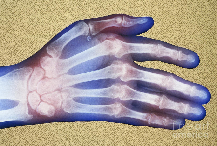 X-ray, Rheumatoid Arthritis Photograph by Chris Bjornberg