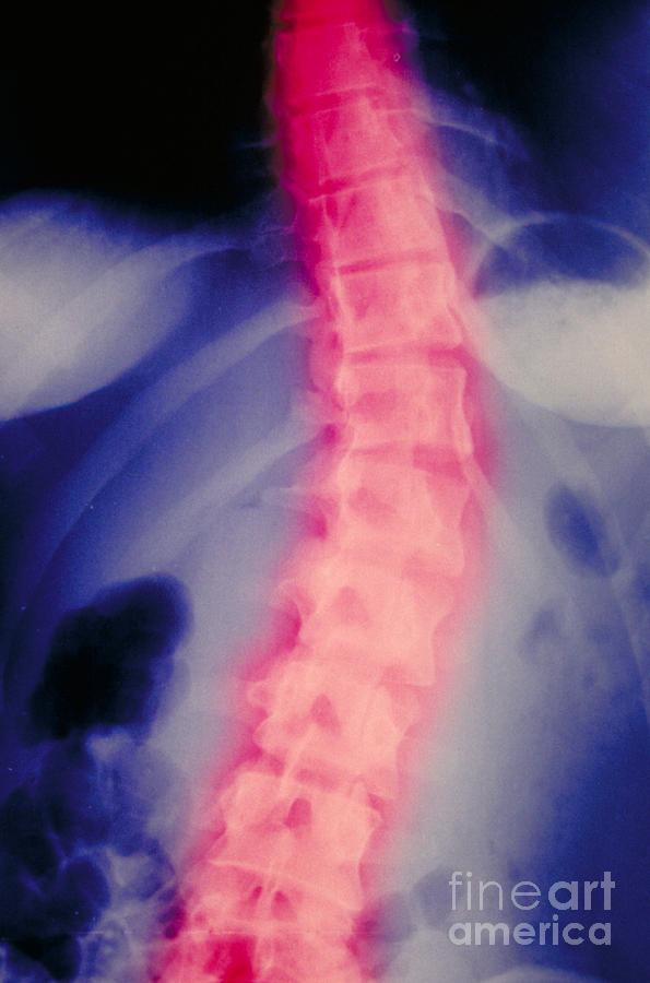 X-ray. Scoliosis Of Spine Photograph by Scott Camazine & Sue Trainor