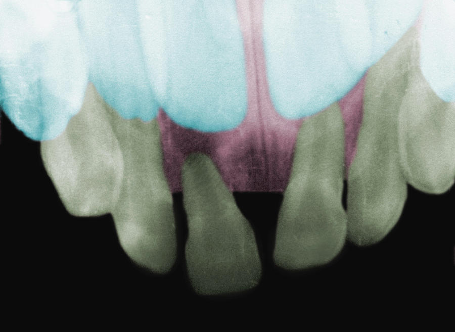 X-ray Showing Baby And Adult Teeth Photograph by Science Stock Photography/science Photo Library