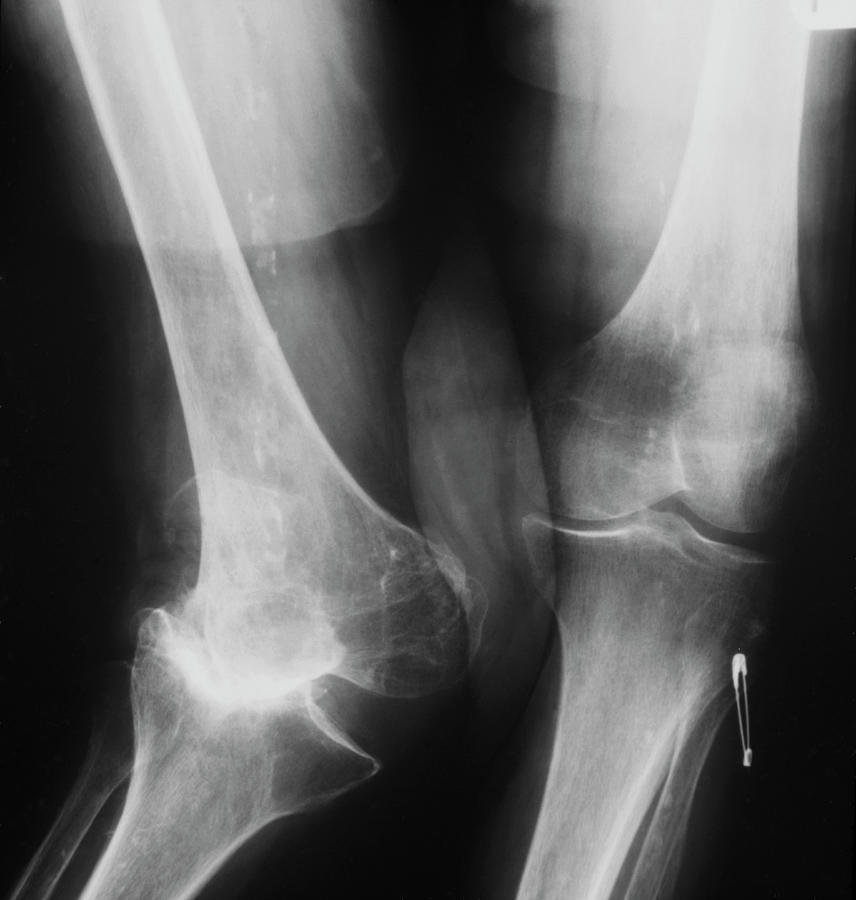 X-ray Showing Congenital Deformity Of The Knee Photograph by Medical Photo Nhs Lothian/science Photo Library