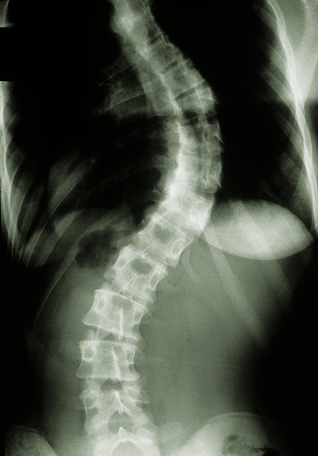 X-ray Showing Scoliosis (curvature) Of The Spine Photograph by Medical Photo Nhs Lothian/science Photo Library