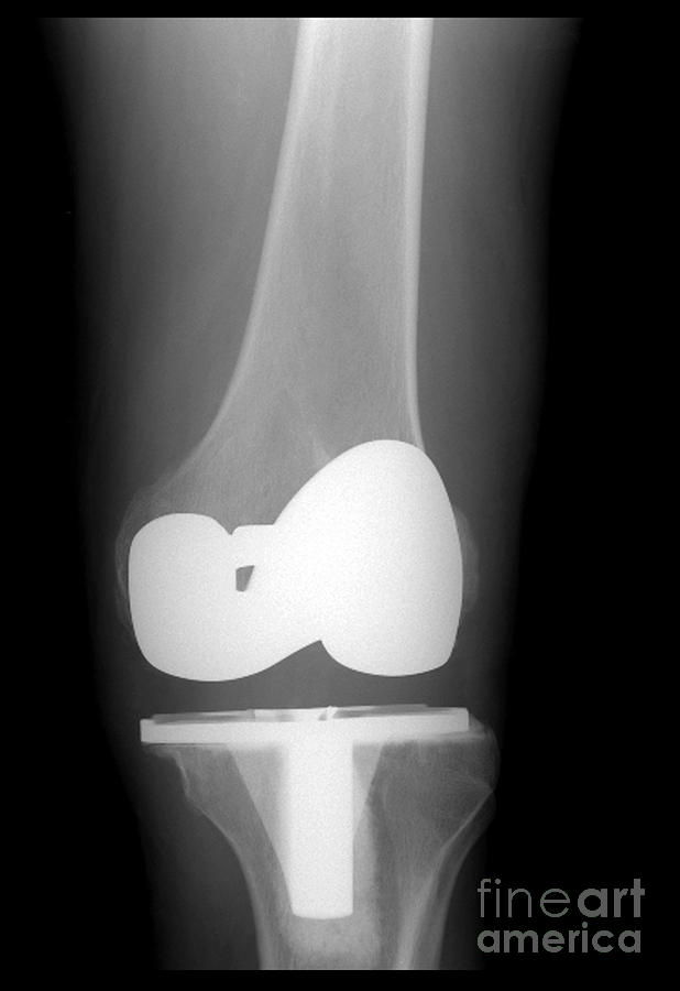 Xray Of Total Knee Replacement Photograph by Living Art Enterprises