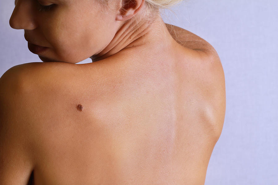 Young woman lookimg at birthmark on  back, skin. Photograph by ChesiireCat