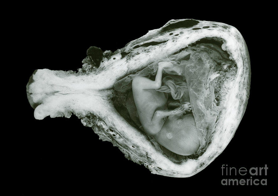 Image Of 13 Week Old Fetus