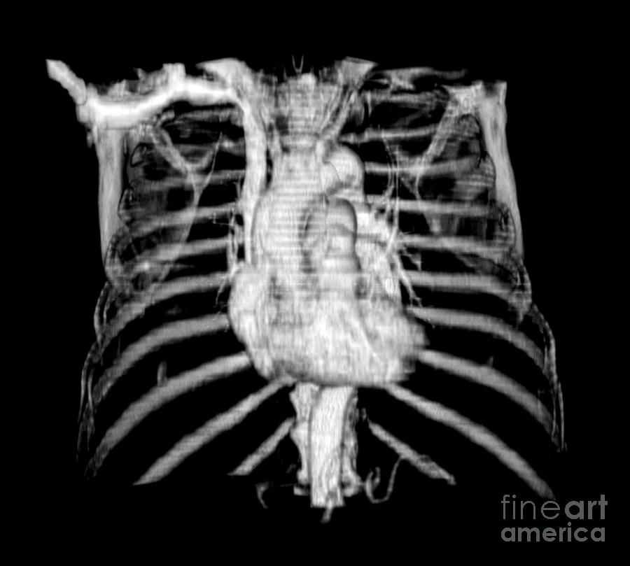 Ct Of Chest Photograph - 3d Ct Reconstruction Of Heart #1 by Medical Body Scans