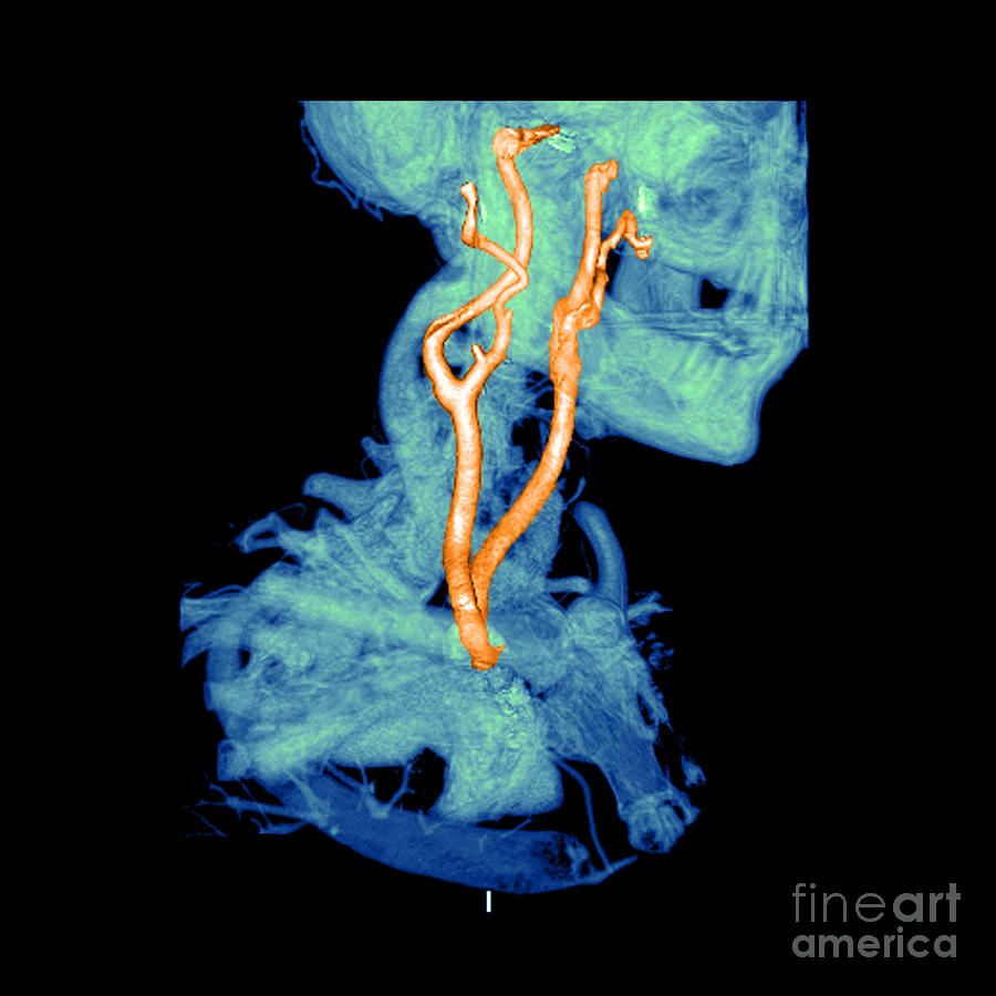3d Cta Of Carotid Arteries #1 Photograph by Medical Body Scans