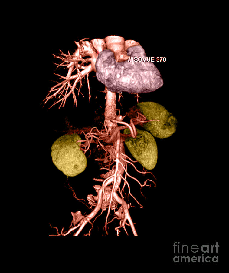 Abdominal Aorta #1 Photograph by Medical Body Scans