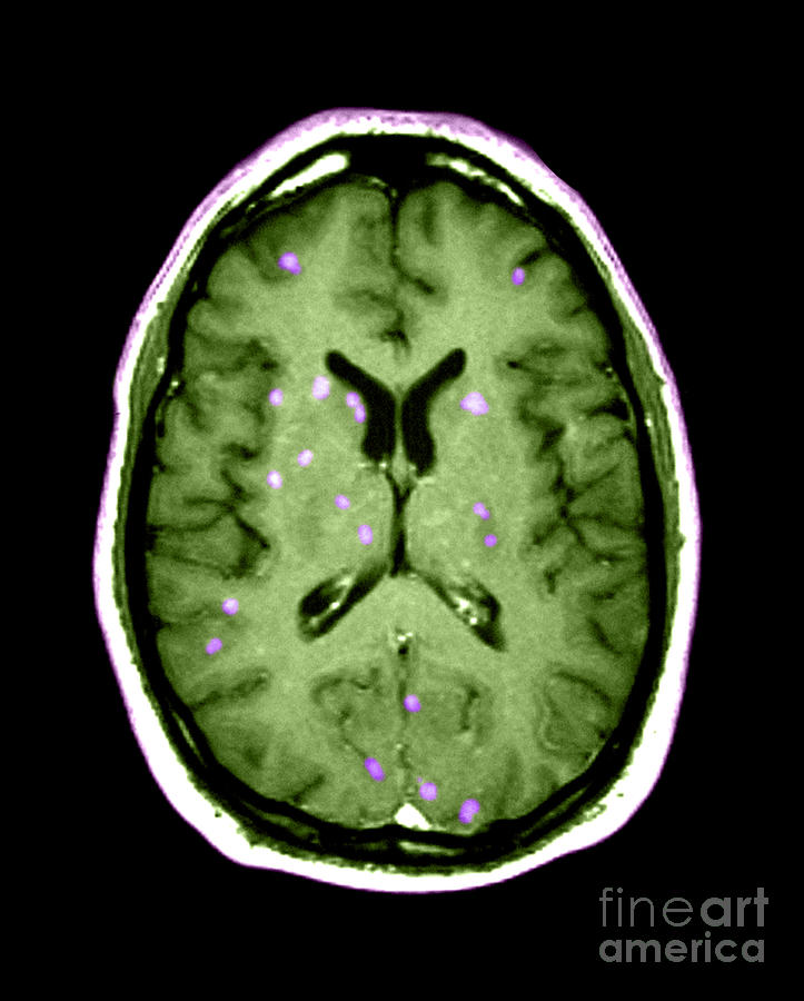 Abnormal Mri Of Brain #1 Photograph by Medical Body Scans