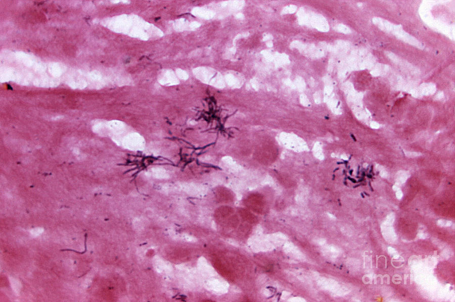 Actinomycosis Infection, Lm #1 Photograph by Science Source