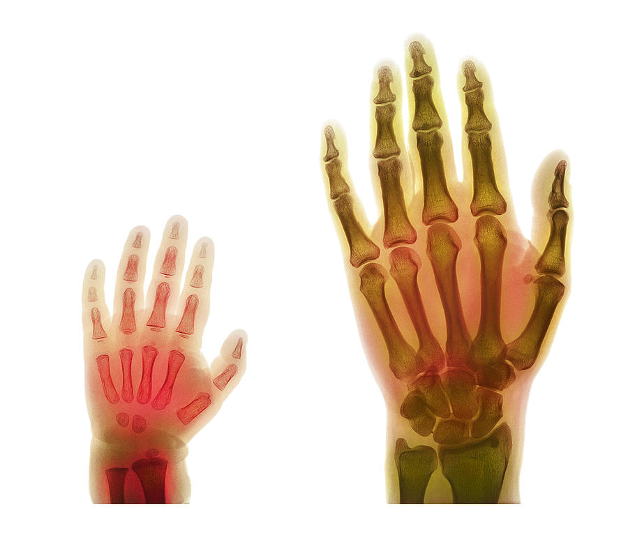 bones of the hand x ray