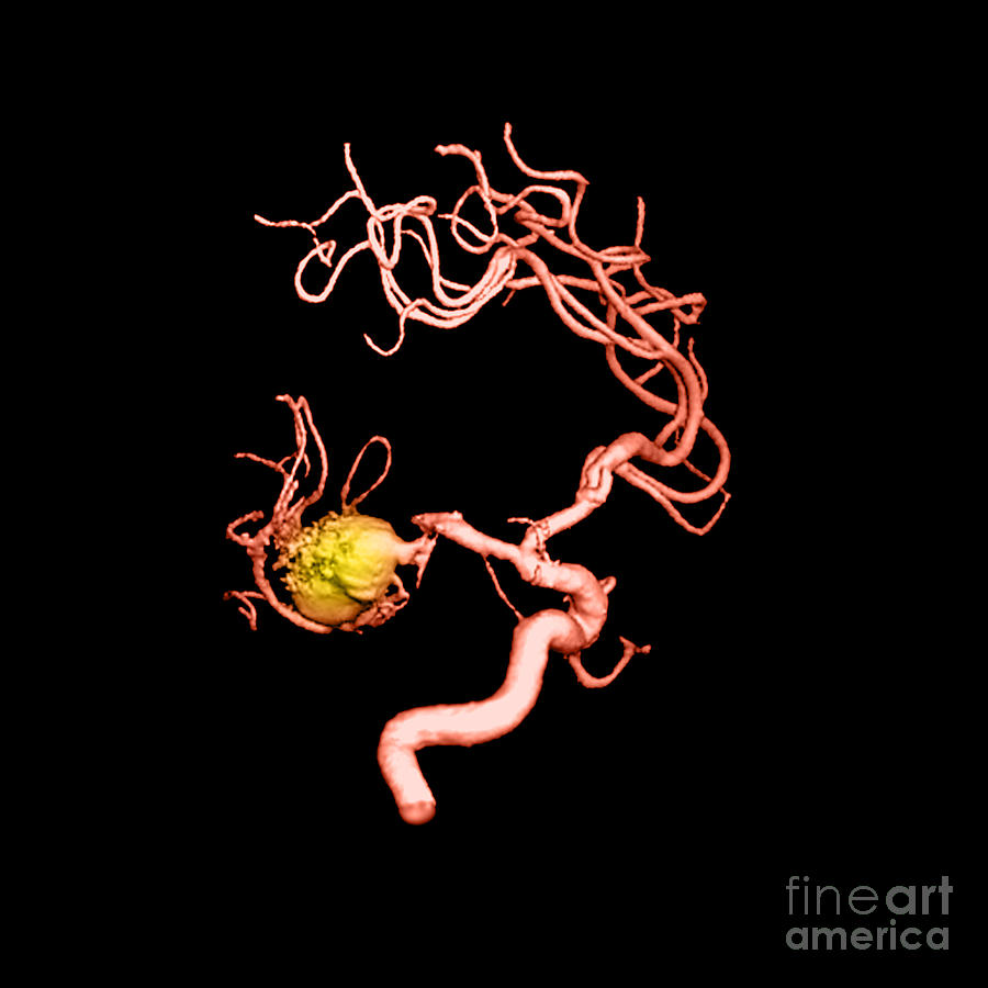 3-d Imagery Photograph - Aneurysm In The Human Brain #1 by Medical Body Scans
