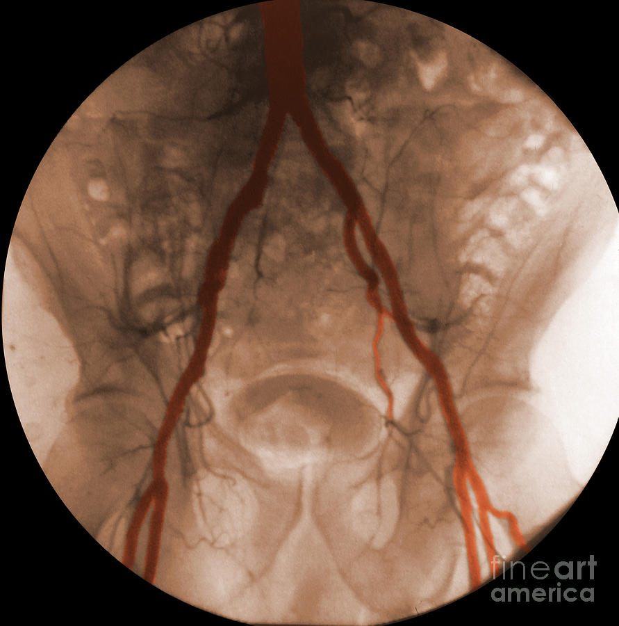 Angiogram Of Iliac Arteries #1 Photograph by Omikron