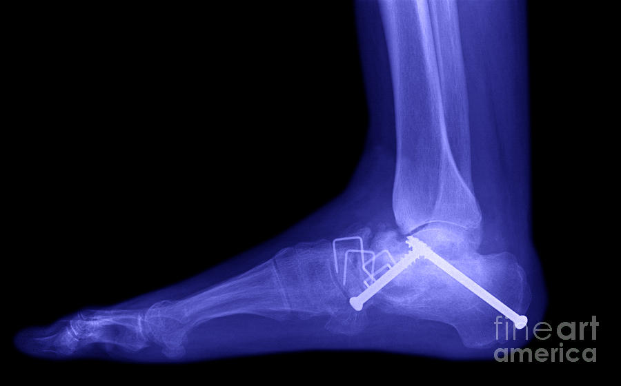 Ankle Fracture #1 Photograph by Ted Kinsman