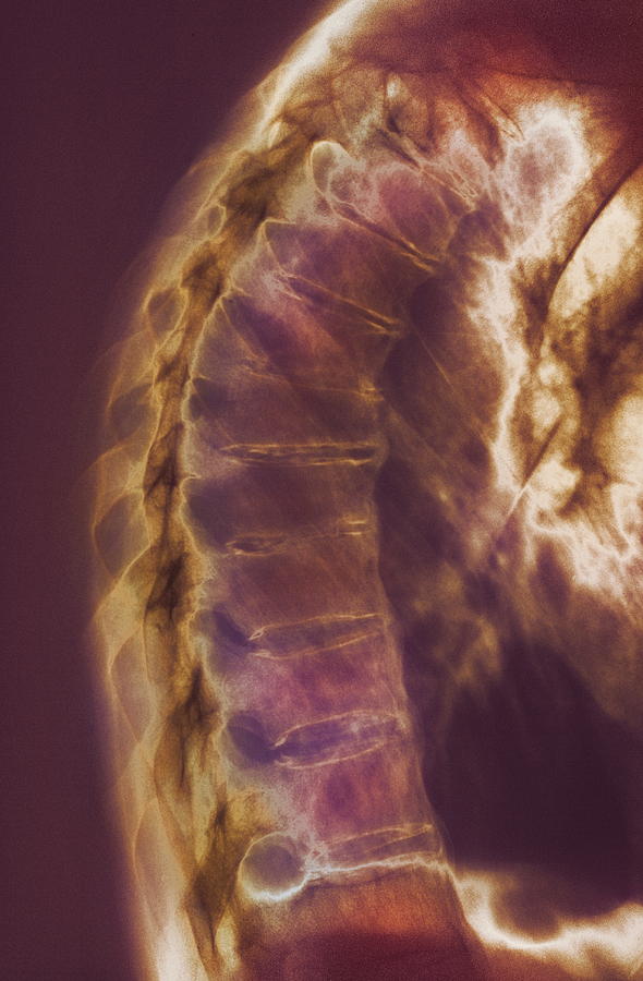 Ankylosing spondylitis cervical spine x ray - questgang